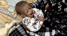 acute malnutrition