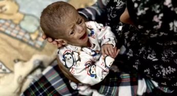 UN and WHO Warn of Surge in Acute Malnutrition Among Children in Gaza