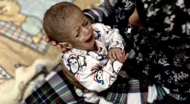 acute malnutrition