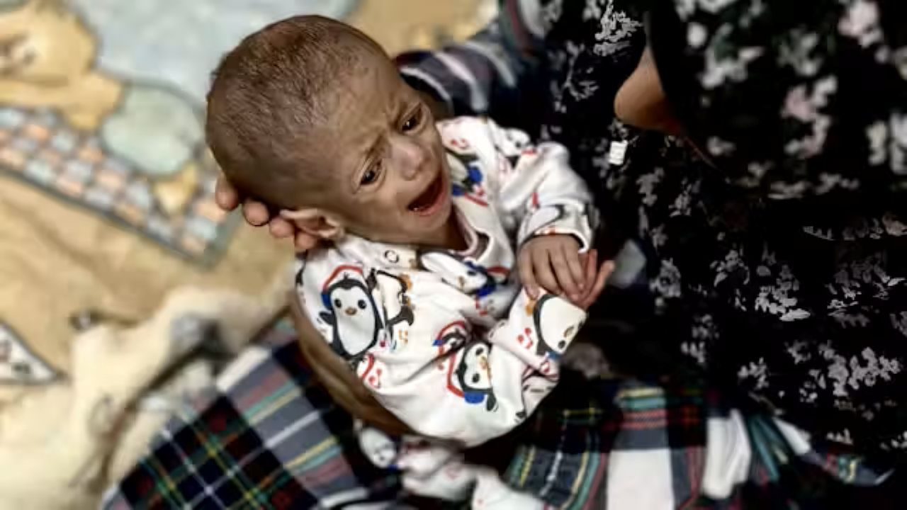 acute malnutrition